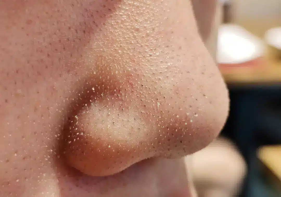 Dermatologista alerta para não espremer os pontinhos pretos do nariz porque eles não são o que você pensa Esses pontinhos pretos no nariz não são cravos de verdade
