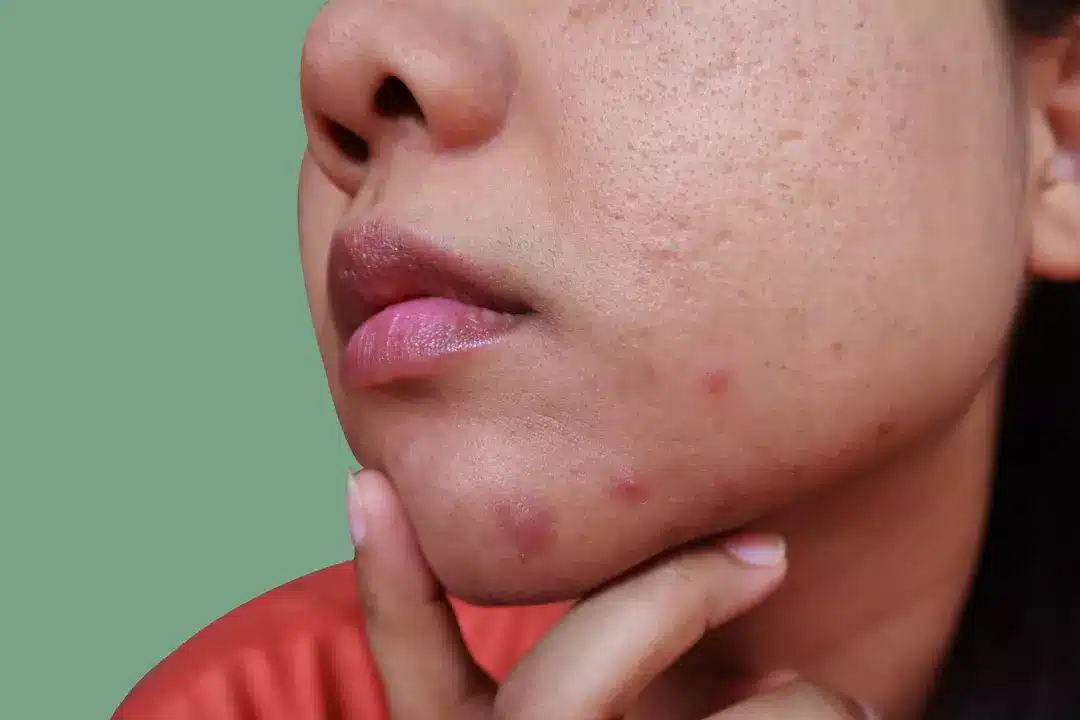 Dermatologista diz que existe um tipo de espinha que você nunca deve espremer no rosto Mas, segundo o Dr. Ellis, você realmente não deve “mexer” em acne cística