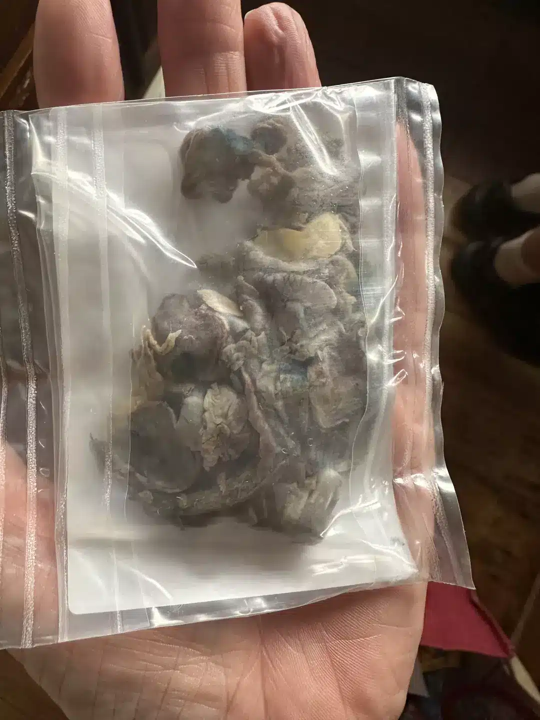 Imagens chocantes mostram o impacto do vape nos pulmões enquanto um adolescente tem órgão retirado do corpo Parte do pulmão dele foi removida (Kennedy News and Media)