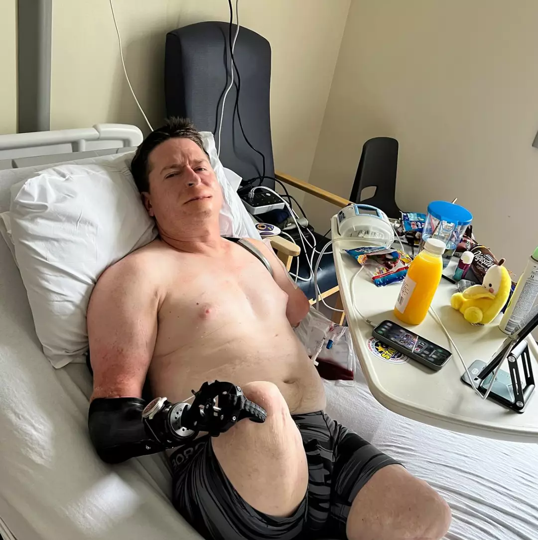 Homem achou que tinha sintomas de gripe, mas acabou precisando amputar todos os membros Ele continua precisando de 'revisões cirúrgicas regulares' (Instagram/@alexlewisalff)