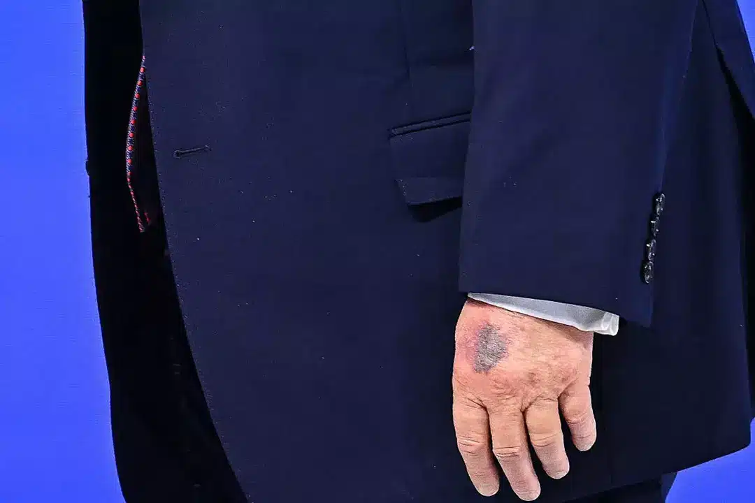 Trump explica o motivo do hematoma na mão após novas fotos despertarem preocupação