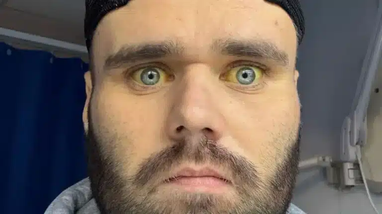 Homem que bebia seis garrafas de vinho por dia relata o impacto horrível que isso teve na saúde dele