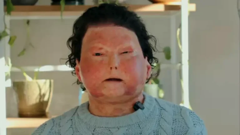 Homem que realizou o primeiro transplante bem-sucedido de rosto e das duas mãos compartilha detalhes gráficos que não pode publicar online
