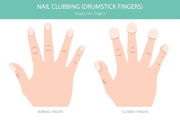 O baqueteamento das unhas pode ser um sinal de câncer de pulmão.