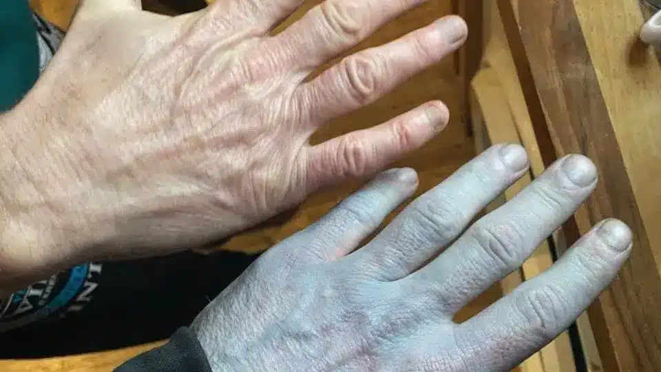 Homem acordou azul e foi levado às pressas ao hospital antes de os médicos “rirem” dele