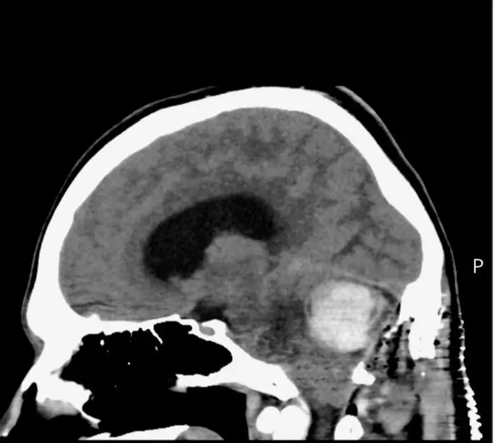 O tumor cerebral de Luke era enorme, mas felizmente benigno e não cancerígeno (SWNS).