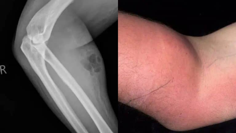 Homem enfrentou consequências perturbadoras após injetar seu próprio esperma para tratar dor crônica nas costas