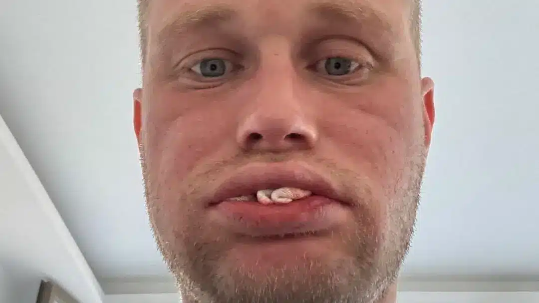 Homem que gastou R$ 23.000 viajando para a Turquia por dentes novos acabou sem nenhum dente
