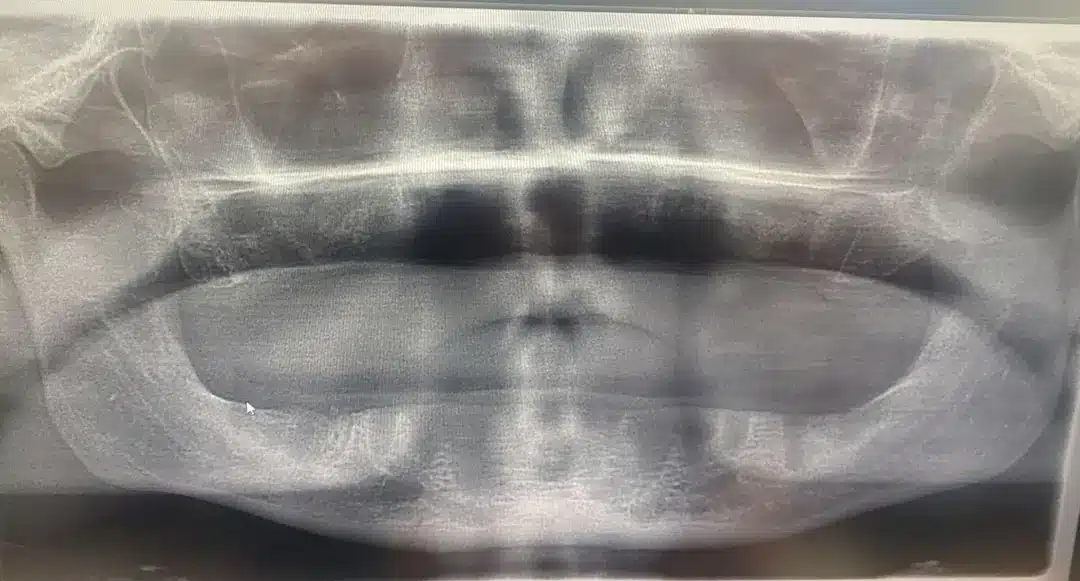 Jon disse que ficou "devastado" ao acordar e descobrir que o dentista havia removido todos os seus implantes (Kennedy News and Media).
