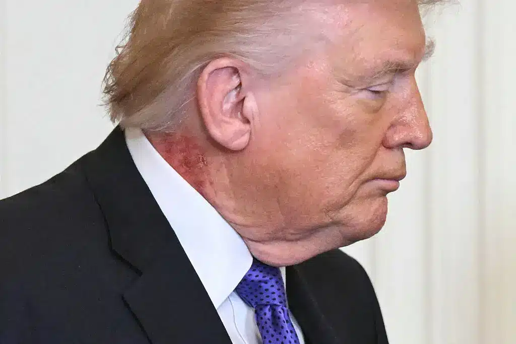 Preocupação com a saúde de Trump após espectadores notarem novo sinal durante discurso à nação