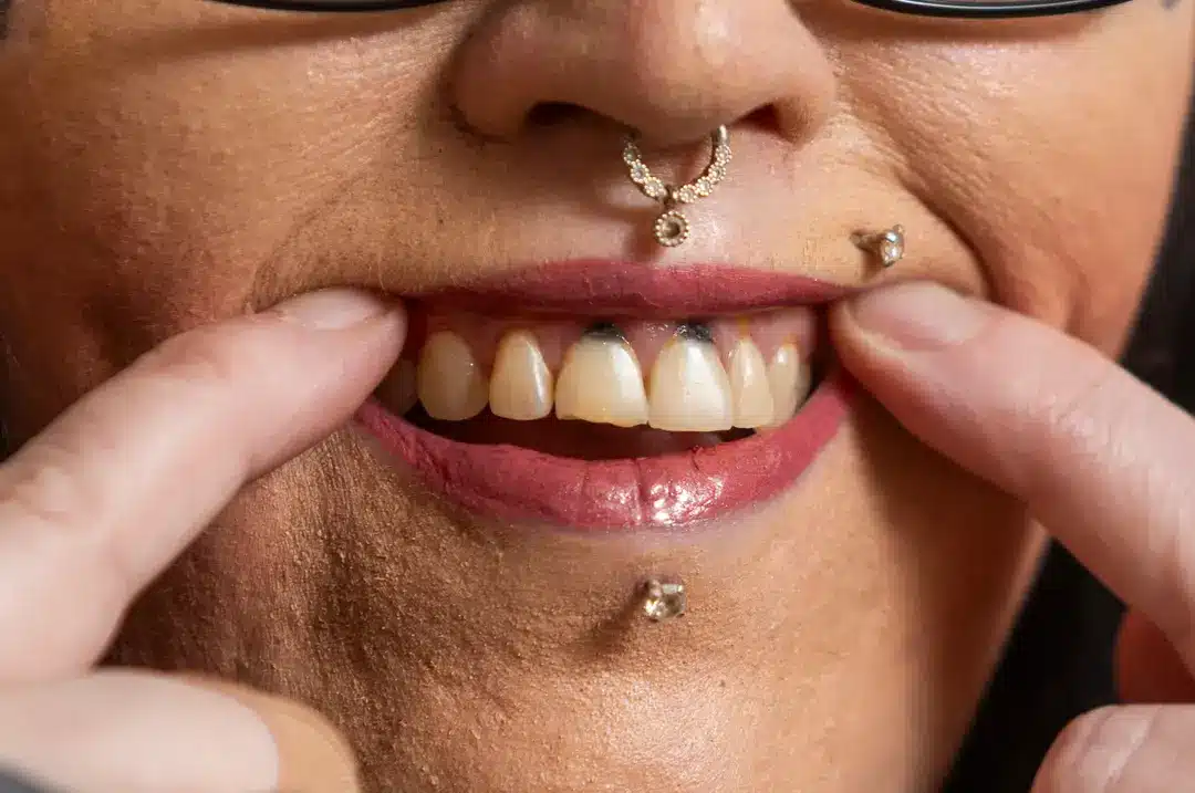 Mulher faz alerta após o vape deixá-la com “dentes pretos”