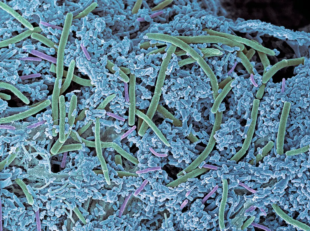 Não é o açúcar: A verdadeira razão pela qual você tem cáries nos dentes As cáries são causadas pela bactéria Streptococcus mutans, que se acumula na placa bacteriana.