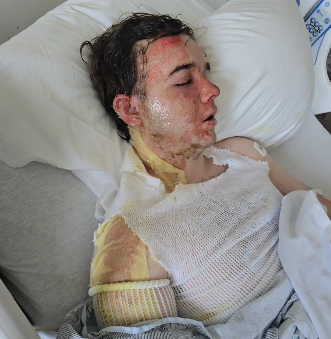 Jacob Smith ficou com dores insuportáveis ​​após o ataque (GoFundMe)