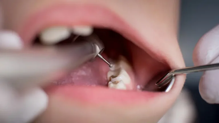 Não é o açúcar: A verdadeira razão pela qual você tem cáries nos dentes